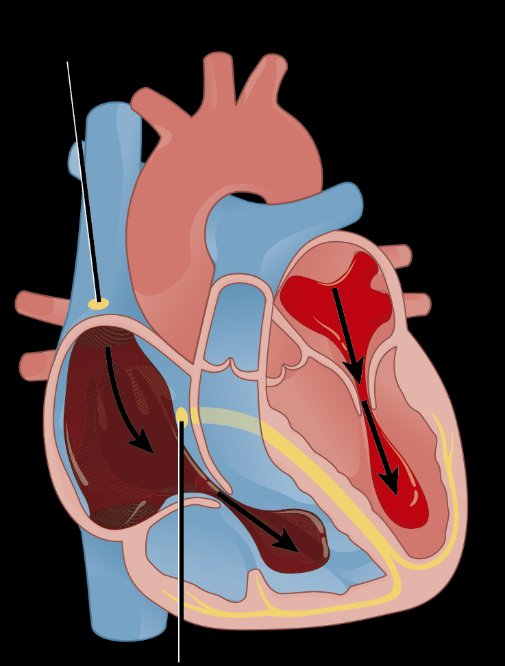 O Que é Extra Sístole Ventricular Cultura Notícias