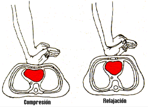 Como hacer una rcp