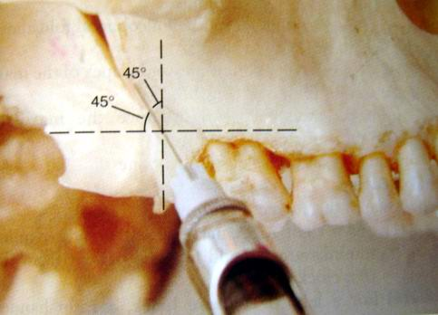 maxillary nerve block high tuberosity approach