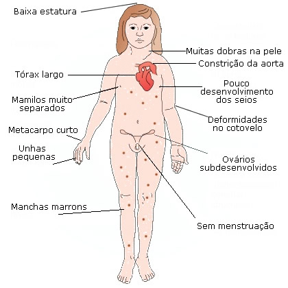 sindrome de klinefelter en mujer