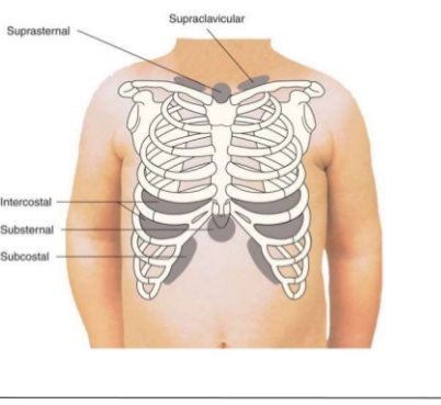 retractions supraclavicular substernal breathing subcostal emaze definition mild distress