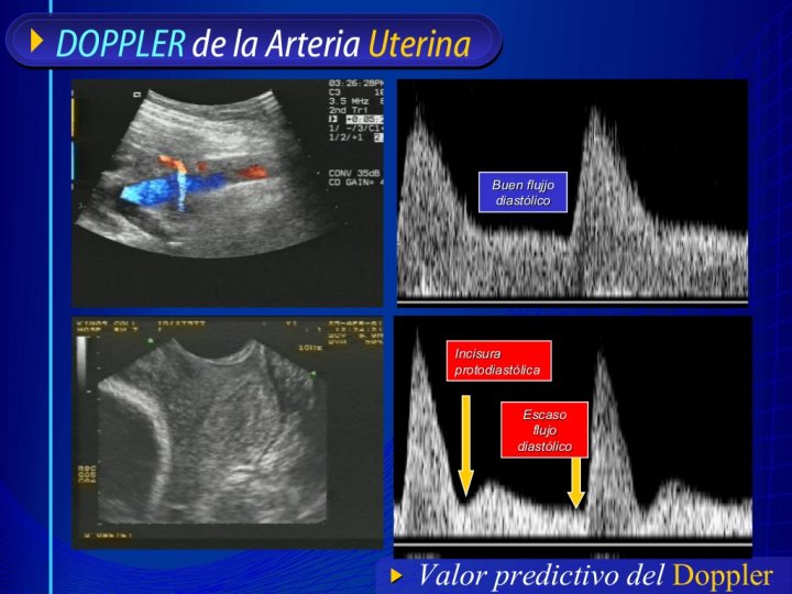 PREECLAMPSIA ECLAMPSIA at emaze Presentation