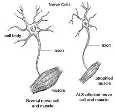 ALS – Lou Gehrig's Disease –