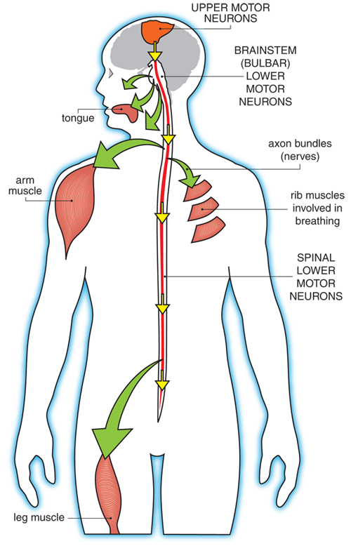 ALS – Lou Gehrig's Disease –