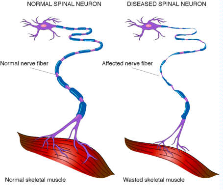 ALS – Lou Gehrig's Disease –