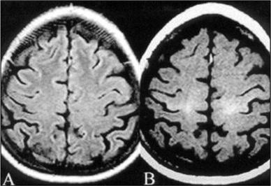 ALS – Lou Gehrig's Disease –