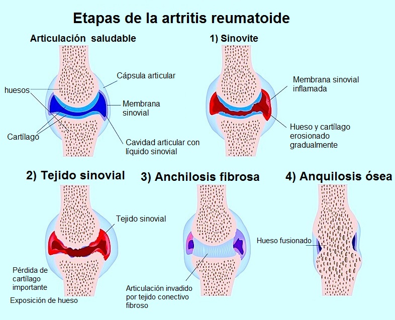 Menu para artritis reumatoide