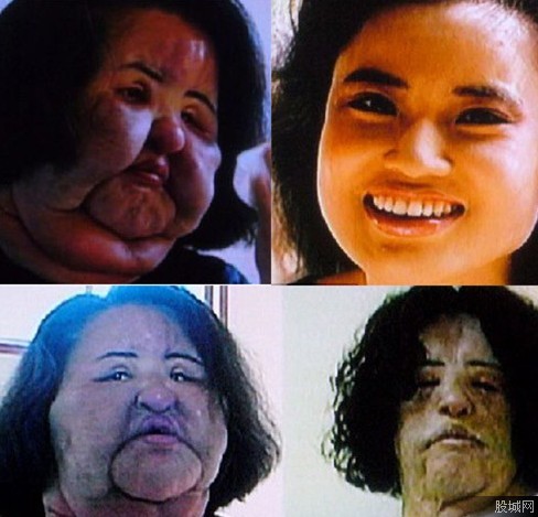 disadvantages of plastic surgery