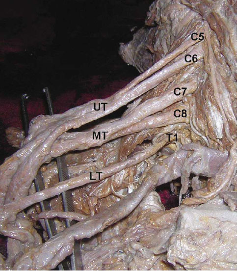 Plexo Braquial On Emaze