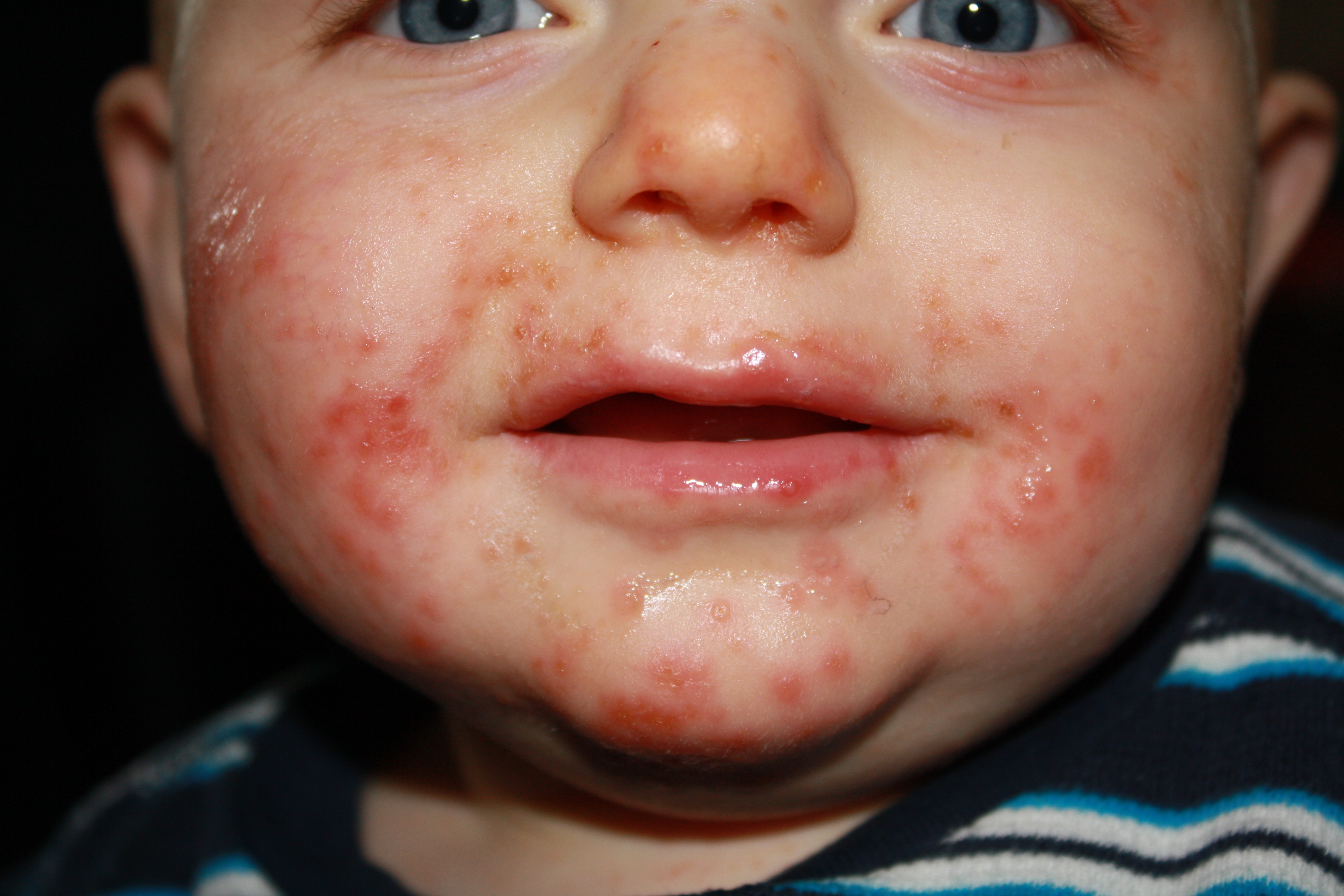 HFMD And 5th Disease On Emaze