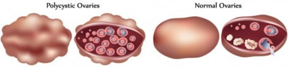 Alimentacion ovario poliquistico