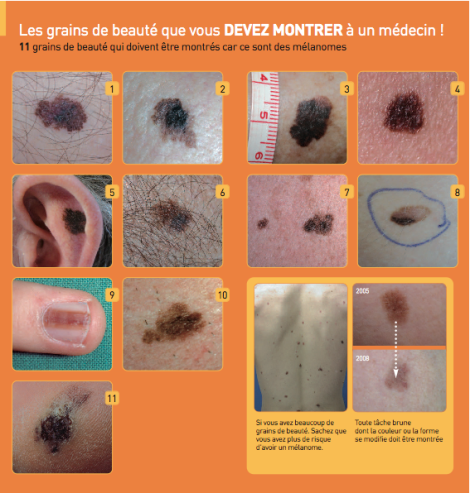 Nous enlevons les taches de pigment par la soude