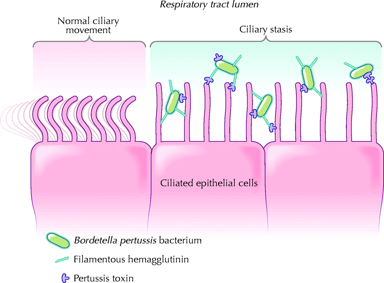 Bordetella пцр. Bordetella pertussis патогенез. Возбудитель коклюша Bordetella pertussis. Патогенез коклюша схема. Патогенез коклюша микробиология.