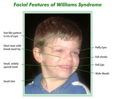 William Syndrome on emaze