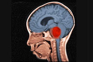 Рак ствола головного мозга. Диффузная глиома ствола головного мозга. Глиома ствола головного мозга у детей.