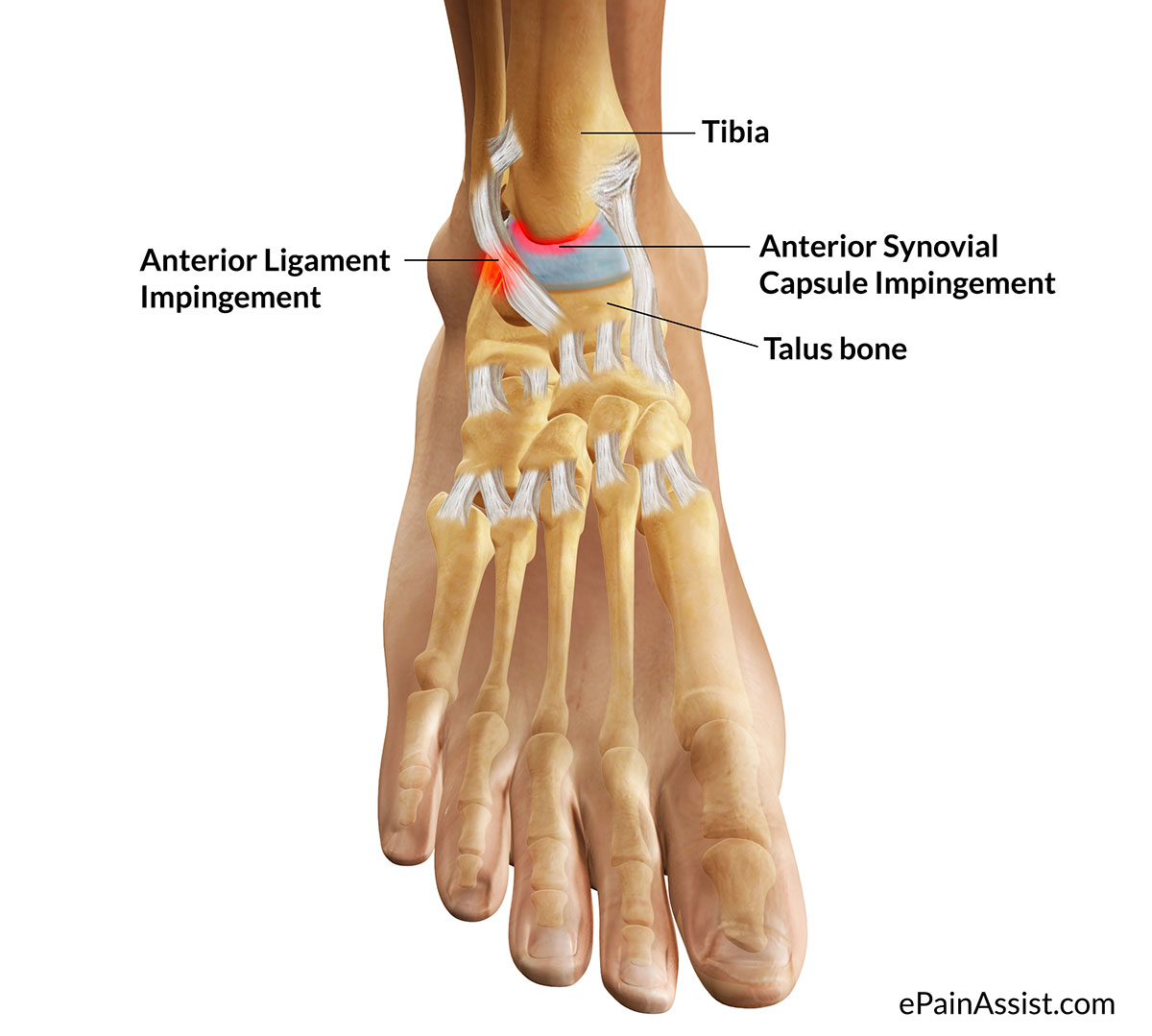 Anterior Impingement On Emaze   8c28ae95 2619 445a B973 849a3863929c 