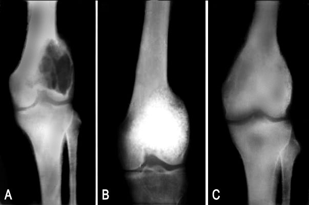 Рак кости ноги. Саркома коленного сустава рентген. Хондрома коленного сустава рентген. Саркома коленного сустава снимки.