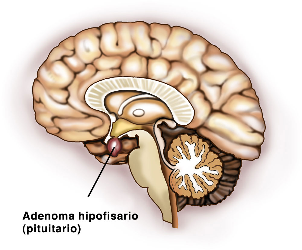 Микроаденома гипофиза головного мозга что это такое. Аденома гипофиза патология. Аденома гипофиза головного мозга что это такое. Интраселлярной аденомы гипофиза.
