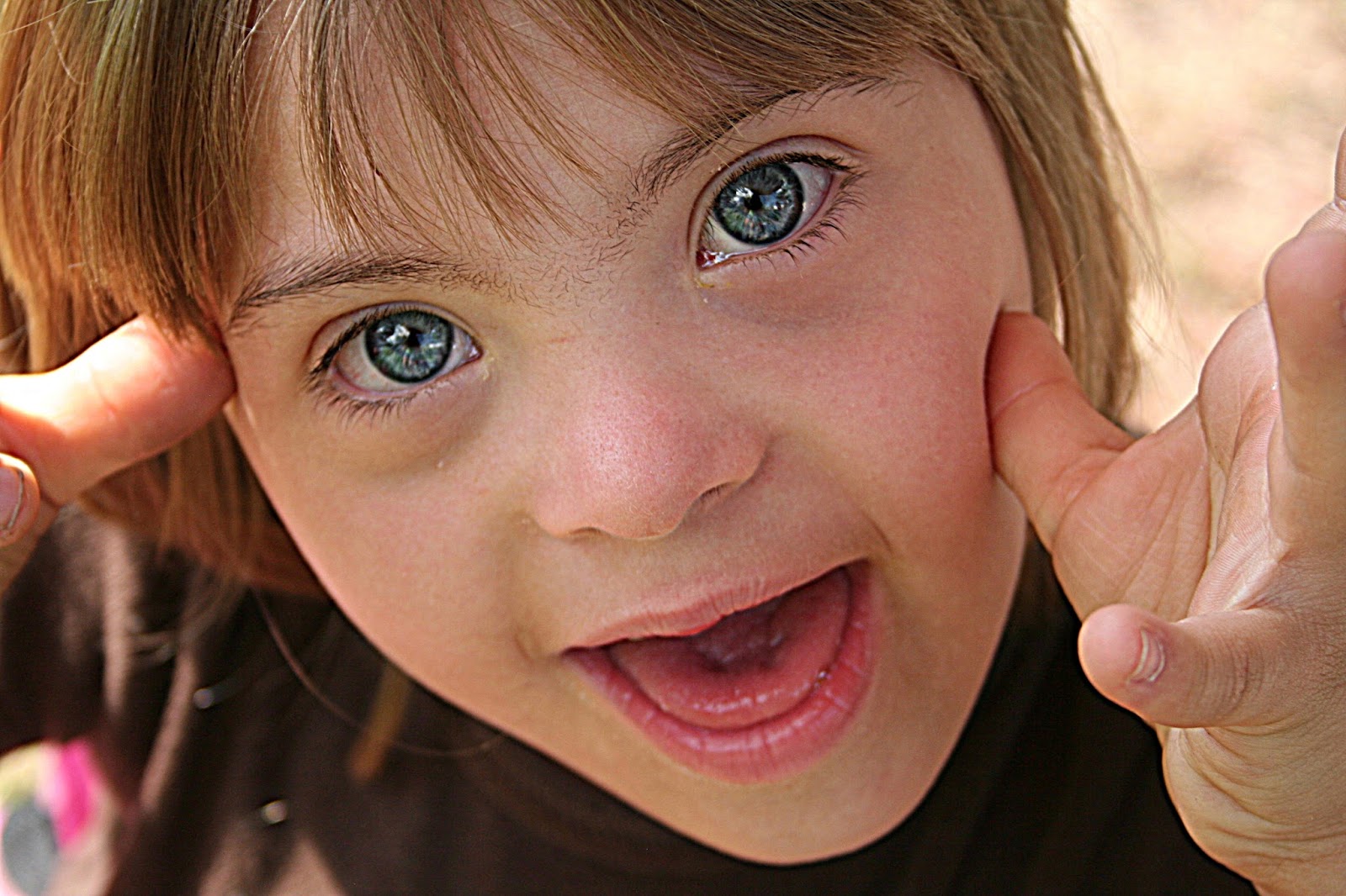 Радужка в глазах у ребенка с синдромом Вильямса