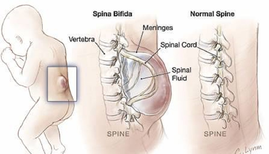 Spina Bifida Having Sex