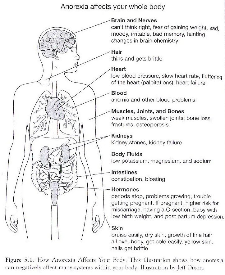 Anorexia on emaze