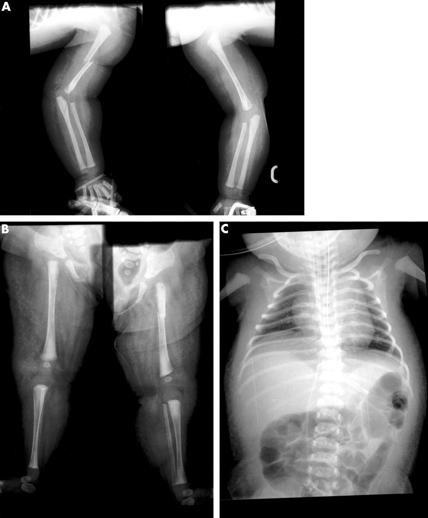 Muscular atrophy. Spinal muscular Atrophy. Спинальная мышечная атрофия 2 типа. Проксимальная спинальная мышечная атрофия 5q.