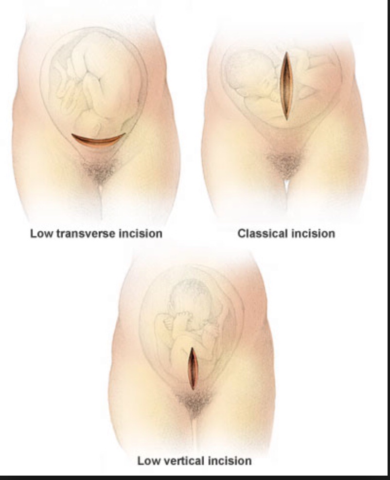 C Section