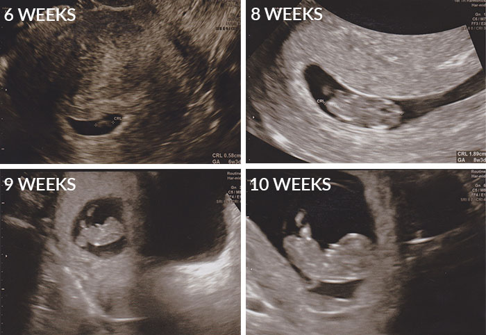 12 неделя беременности определить пол ребенка