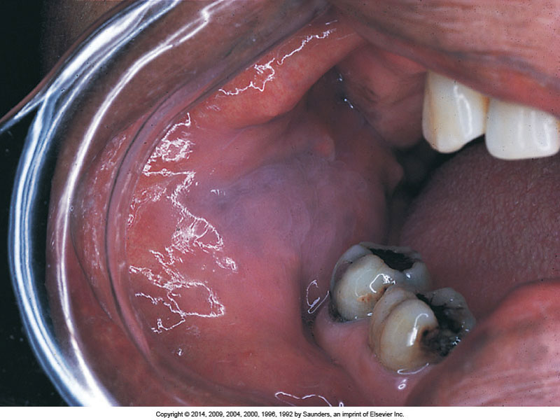 oral pathology