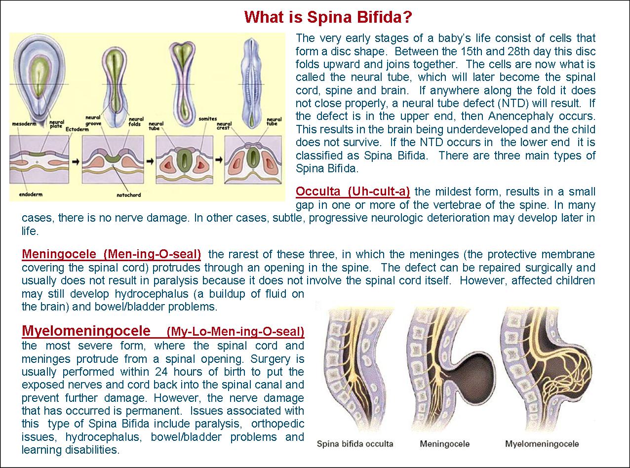 Spina bifida. Классификация спина бифида s1. Спина бифида Оккульта кт.