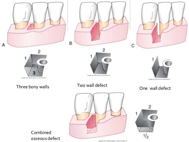 Bone Loss Patterns