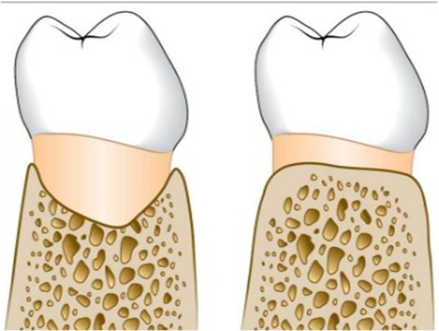 Деструкция костной ткани. Деструкция костной ткани в стоматологии. Отслоение костной ткани в Десне. Деструкция костной межзубного пространства. Межпроксимальная поверхность зубов.
