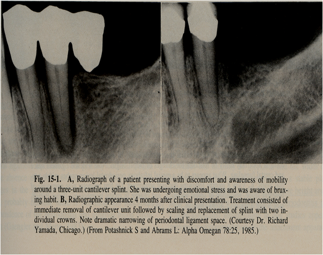 Bone loss& patterns at emaze Presentation