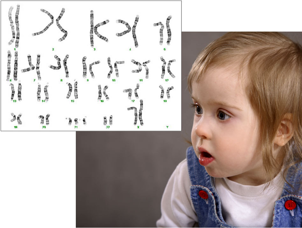 Дети с хромосомными нарушениями. Лишняя 21 хромосома