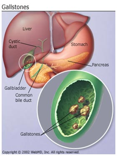 Minati Mondal is stunned after doctors find 12,000 GALLSTONES inside her