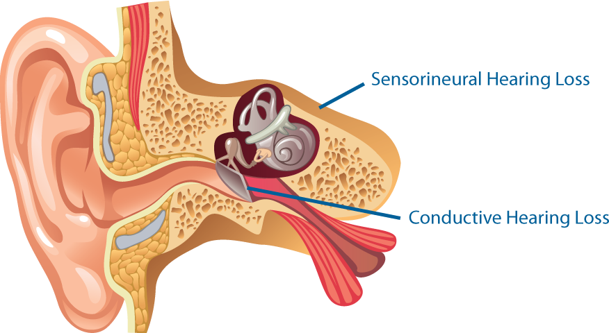auditory nerve damage repair