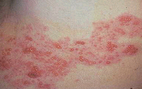 Antiviral for chickenpox Antiviral for chickenpox