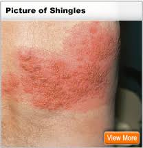 shingles research on emaze