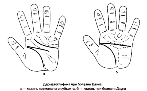 Четырехпальцевая складка на ладони фото