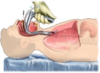 intubacion