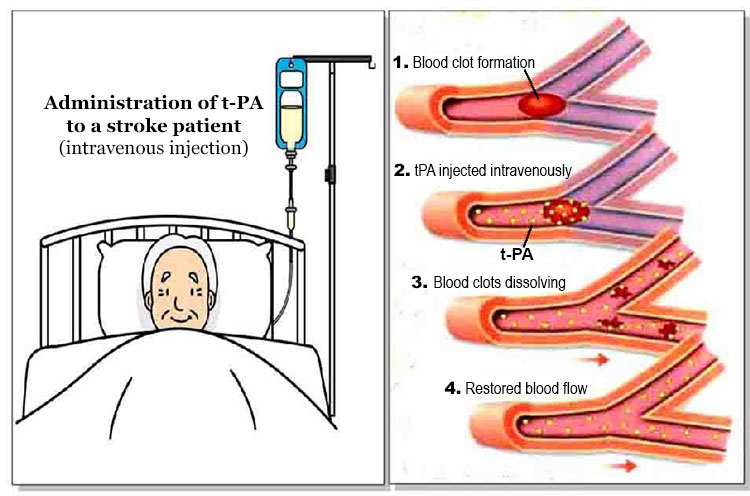 Image result for thrombolysis stroke
