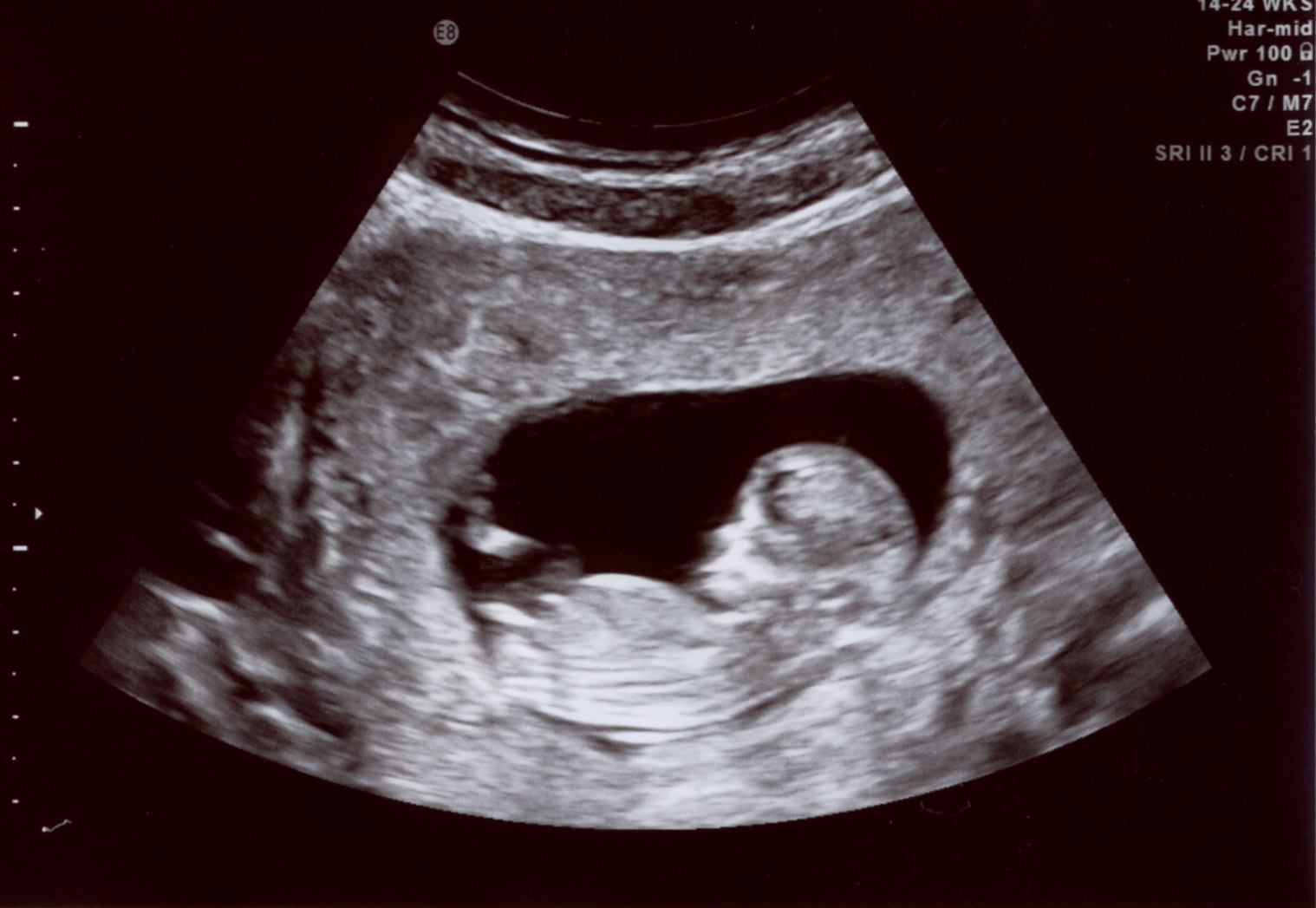 УЗИ 13 недель беременности мальчик