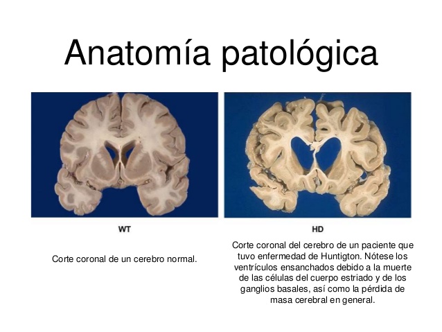 Enfermedad De Huntington 5898