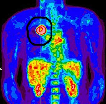 Позитрон-эмиссионная томография. Пэт кт снимки. Позитрон-эмиссионная  томография: пэт. Пэт кт почки. Пэт кт почки.