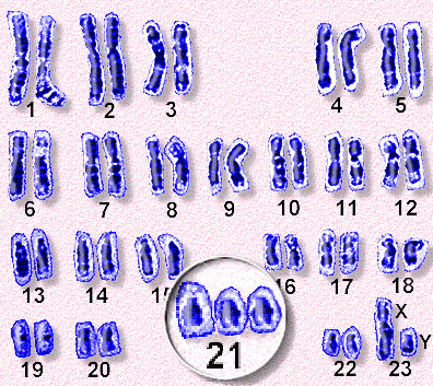 Набор дауна. Синдром Дауна хромосомная карта. Синдром Дауна 21 хромосома. Кариограмма синдрома Дауна. Синдром Дауна набор хромосом.