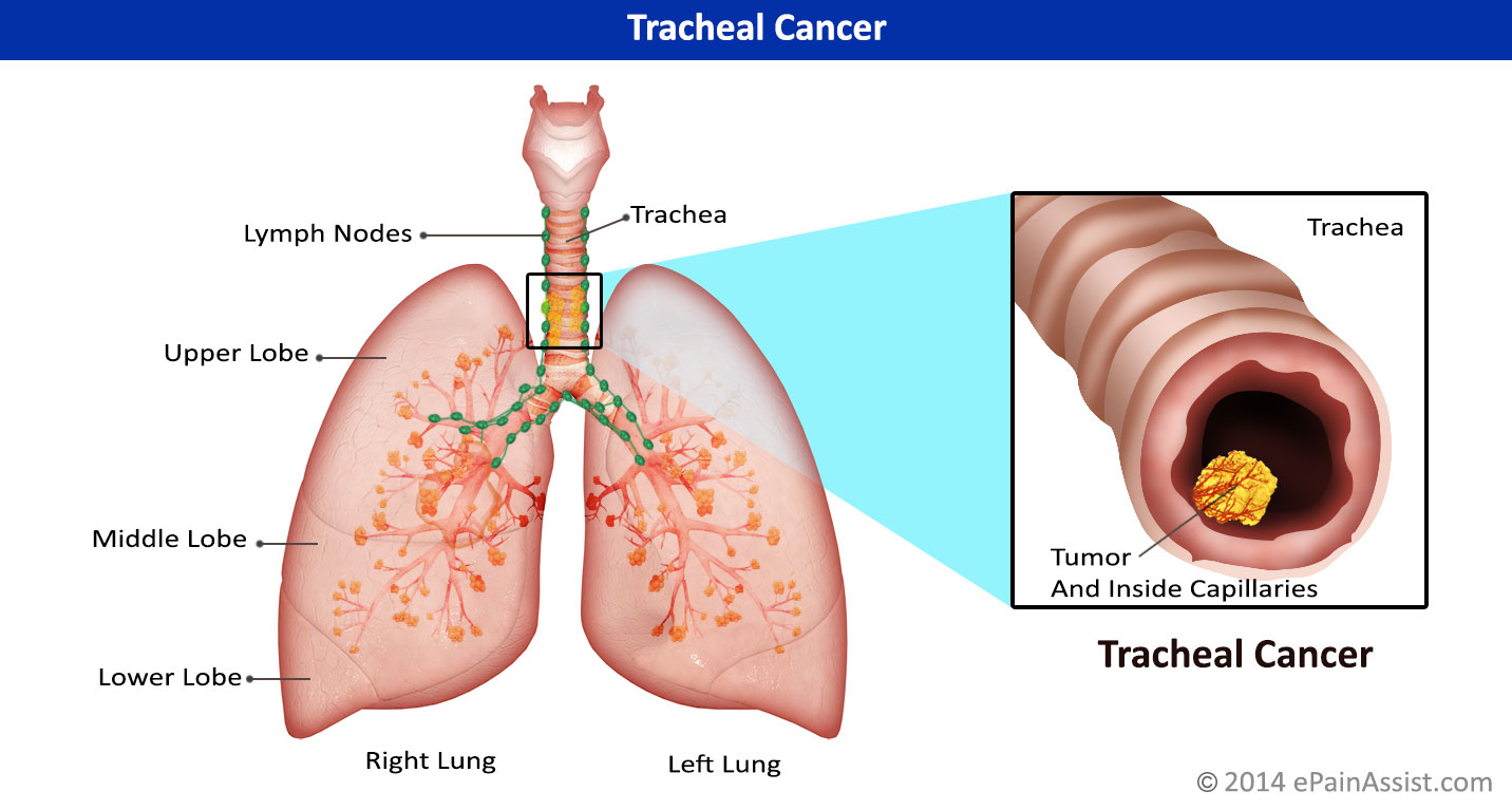 Лечение рака трахеи. Опухоль трахеи симптомы. Опухоль на трахее у человека.