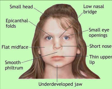 Image result for digeorge syndrome