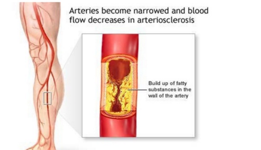 Лечение атеросклероза артерии. Облитерирующий атеросклероз сосудов конечностей. Облитерирующий атеросклероз сосудов ног. Локализации атеросклероза артерий конечностей. Стеноз артерий нижних конечностей.