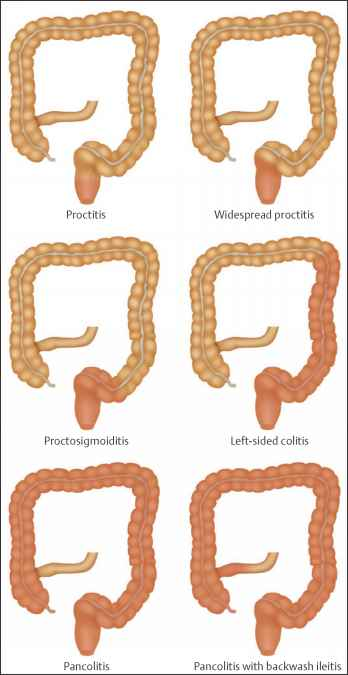 Ulcerative Colitis on emaze