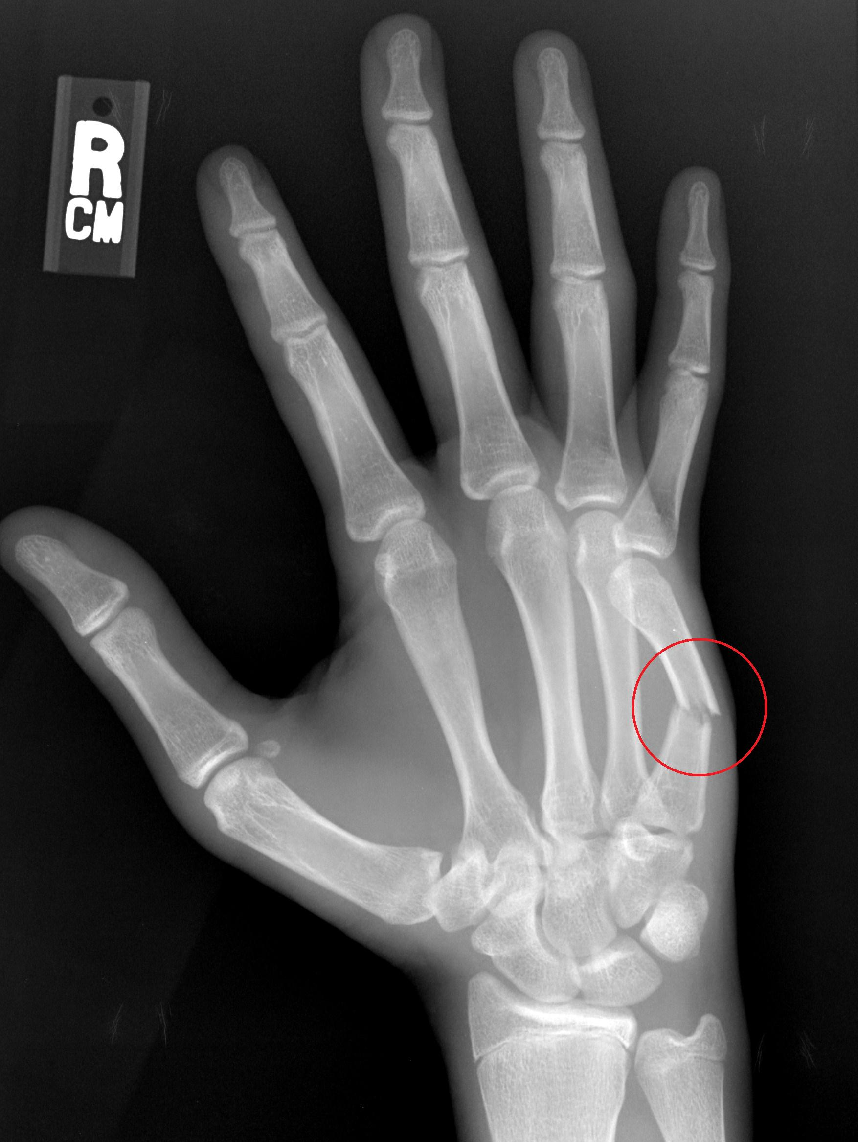 boxer's fracture at emaze Presentation